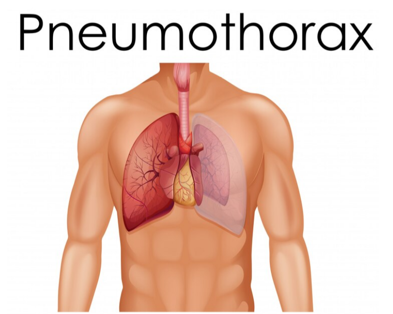 ما هي مضاعفات التهاب الشعب الهوائية؟